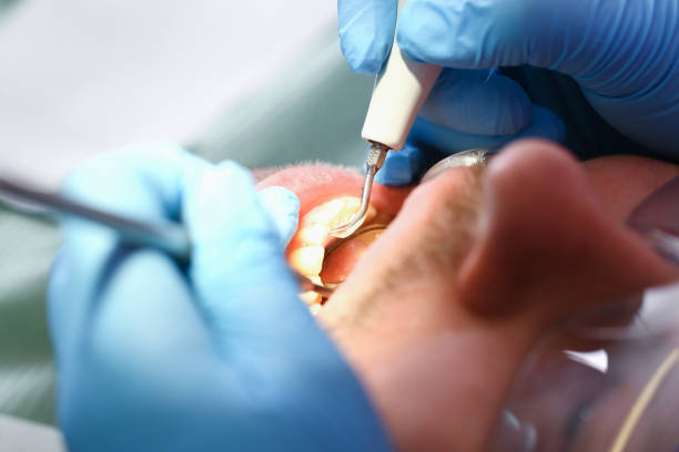 Best Emergency Dental Care for Broken or Chipped Teeth in Rice, MN