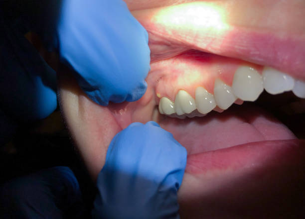 Best Emergency Wisdom Teeth Removal in Rice, MN